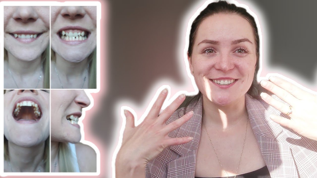 ZDJĘŁAM APARAT ORTODONTYCZNY PO 4 LATACH?!Koszt założenia i wady noszenia