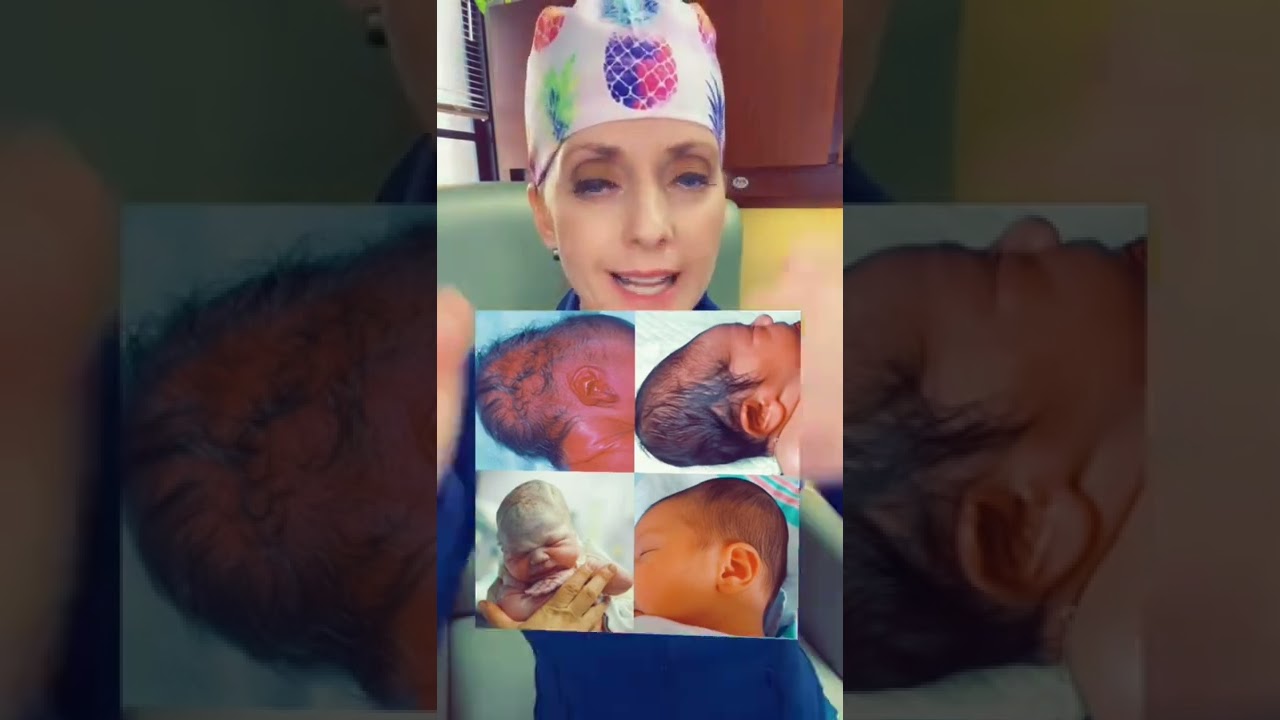 Newborn conehead or caput! #conehead #caput #birth #childbirth #laboranddelivery
