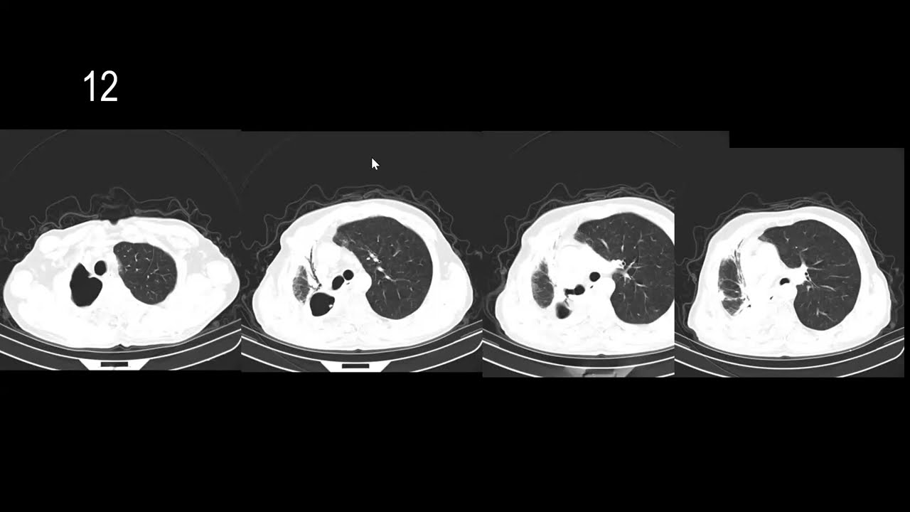 Thoracic Radiology Spotters | MD/DNB/DMRD Exam Preparation