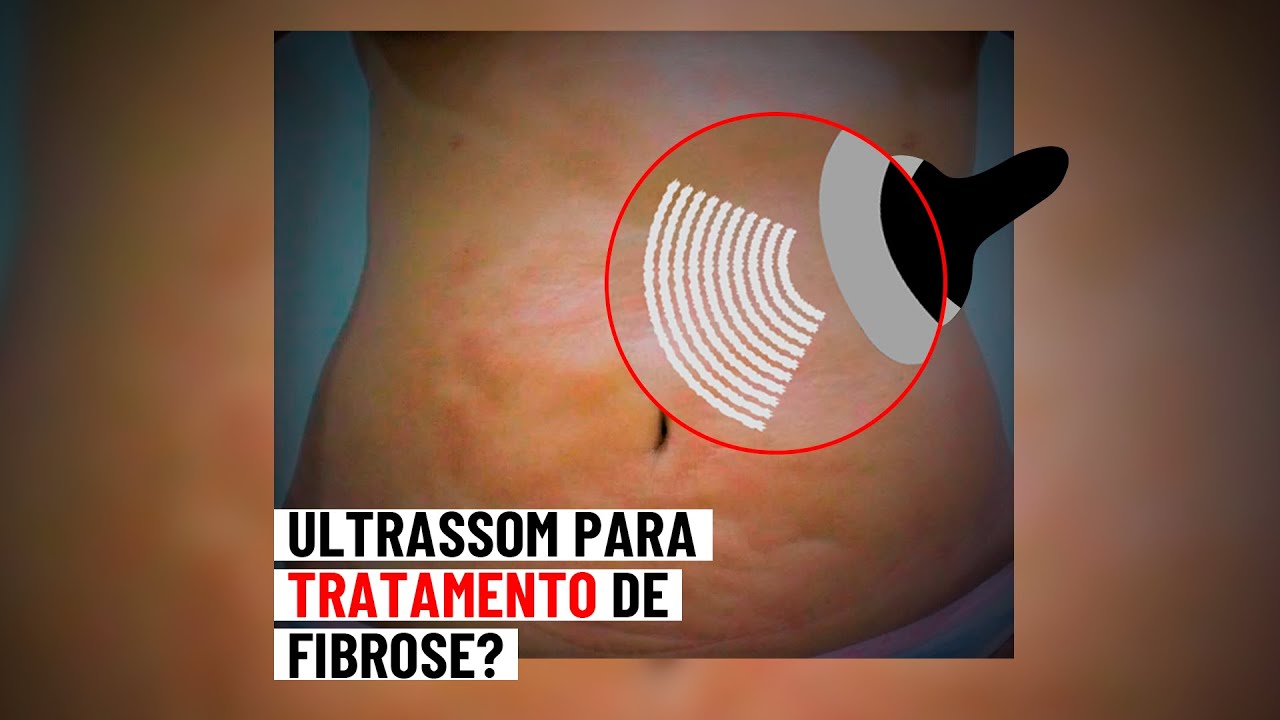 Ultrassom é uma boa opção para o tratamento de fibrose? Pergunte #138