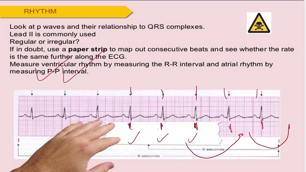 lecture 18 - Practical - ECG Arrhythmias