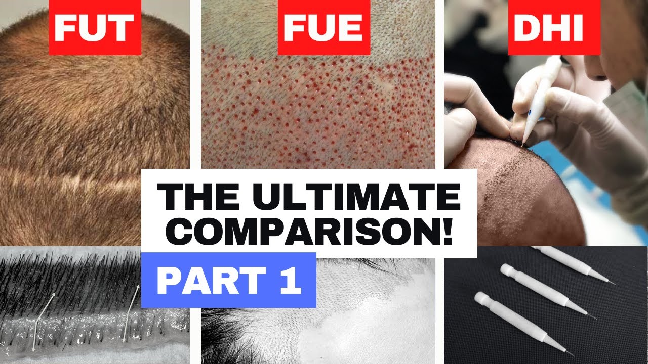 FUE vs DHI vs FUT - The Ultimate Comparison! PART 1