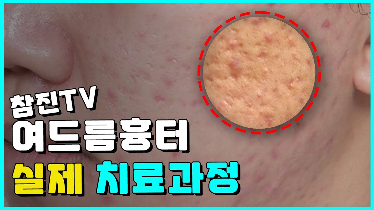 여드름 흉터 치료! 참진한의원 흉터 치료 과정 공개!!! 🔥#여드름압출 #여드름 #여드름흉터한의원