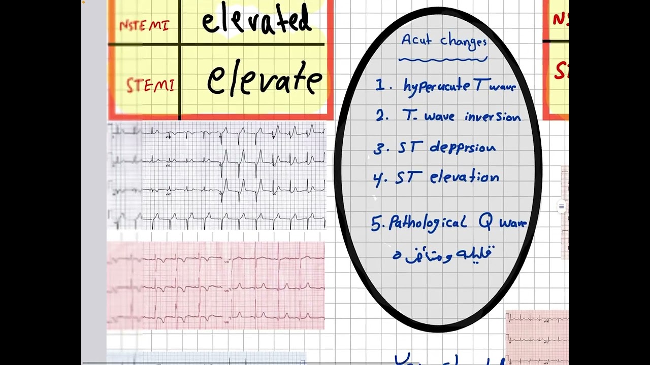Cardiology // Coronary artery disease 2