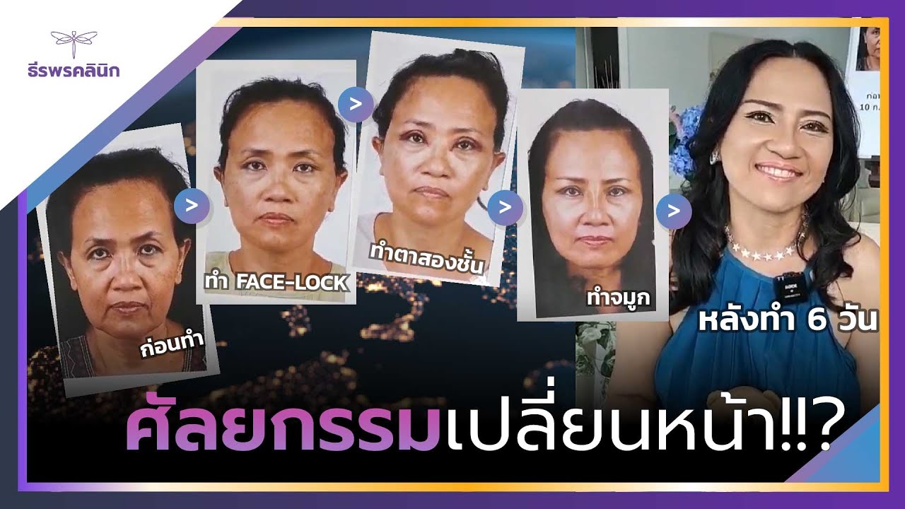 เรื่องจริง!! หรือ เรื่องหลอก!? คนเดียวกันไหม ? ศัลยกรรม 3 อย่าง ตา จมูก ดึงหน้า สาวจากCanada