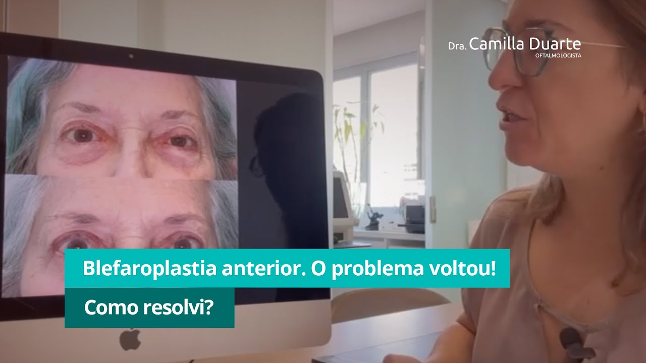 Ela já tinha operado as pálpebras há 25 anos, mas o problema voltou. Veja como eu resolvi!