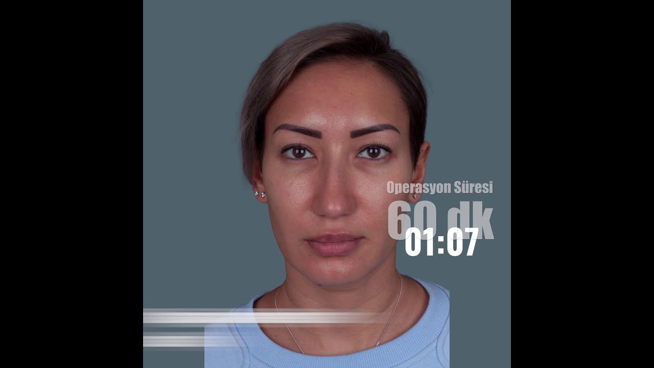 Blefaroplasti