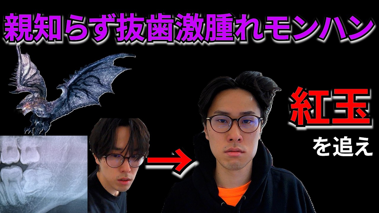【モンハンXXXX】親知らずドリル抜歯界隈、激メロの模様