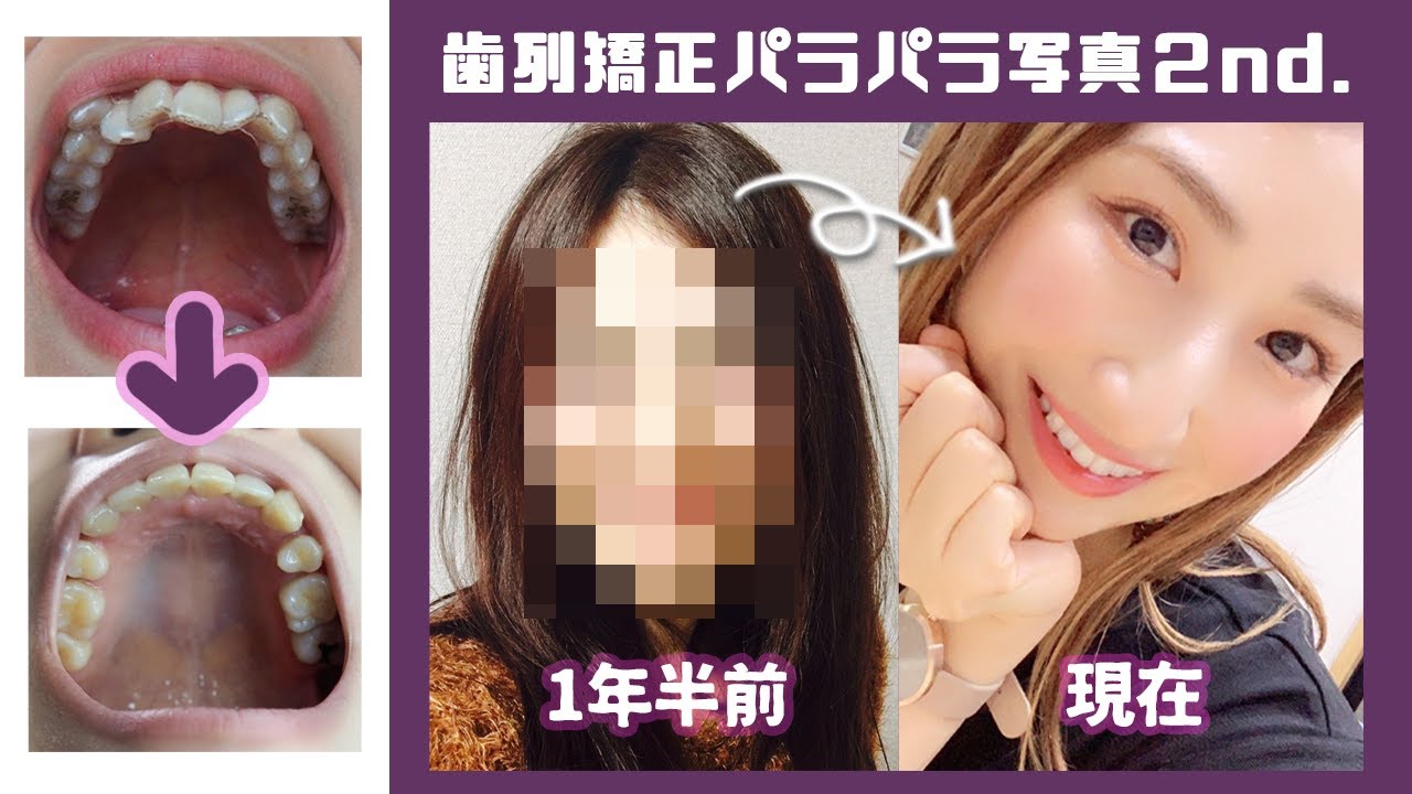 #50 【整形級】歯列矯正1~50週の歯の動きの過程全部見せます！ビフォーアフター パラパラ写真2nd.!