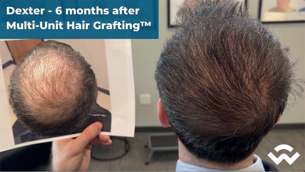Amazing 6-Month Crown Transformation: Dexter’s Hair Transplant Results