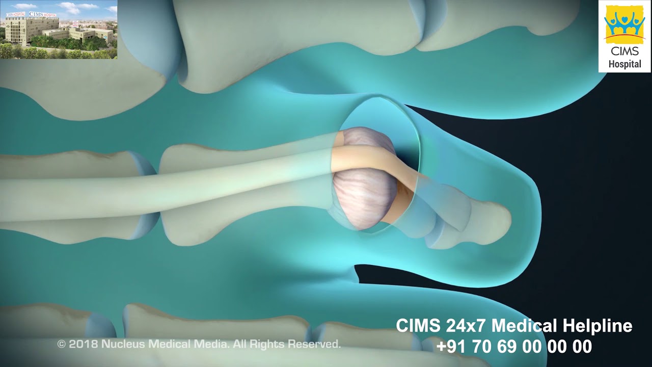Hammertoe and Claw Toe Correction – CIMS Hospital