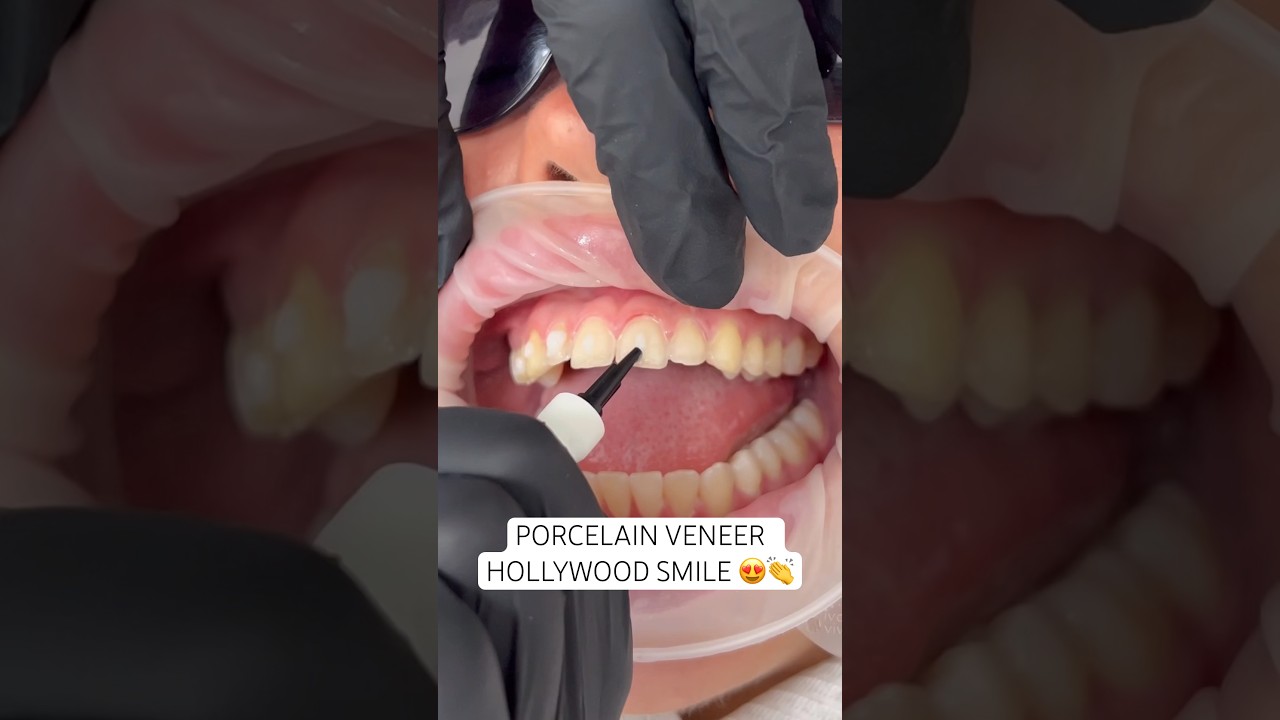 Bright, white Hollywood smile that will last 20+ years ❤️ #porcelainveneers