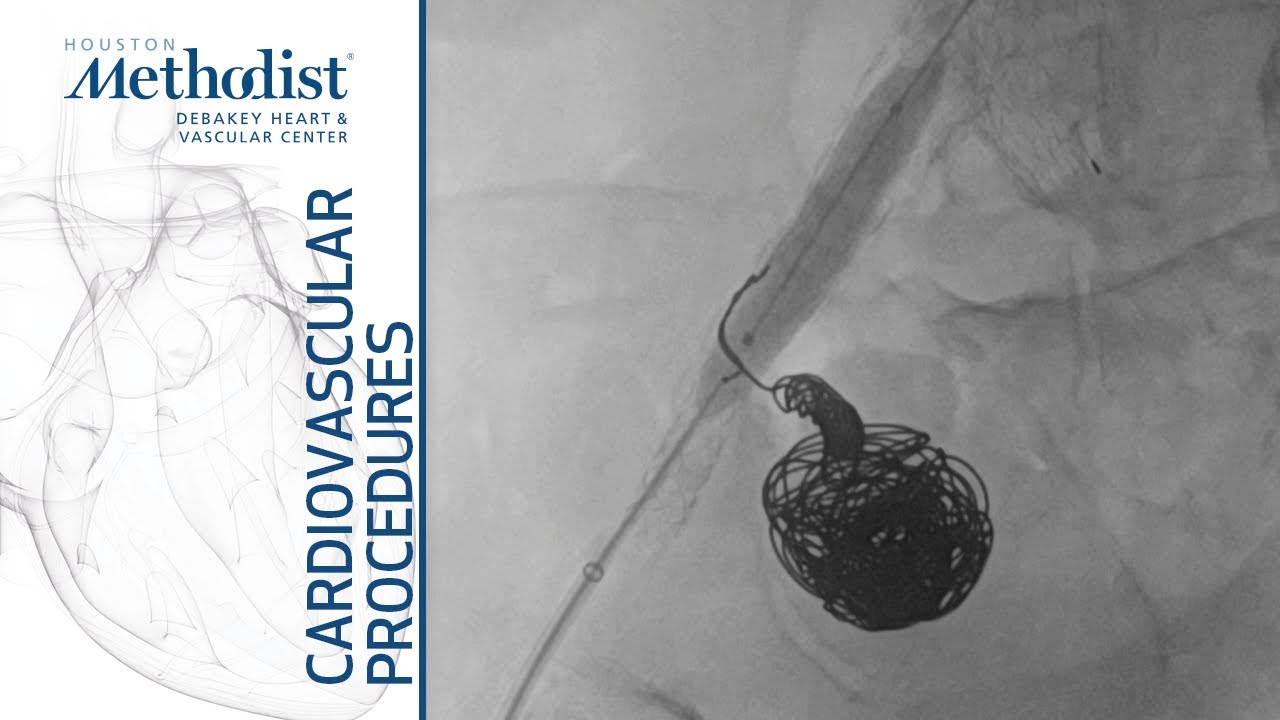 Coiling and Stent Grafting of Internal Iliac Aneurysm (Alan B. Lumsden, MD, Ross G. McFall, MD)