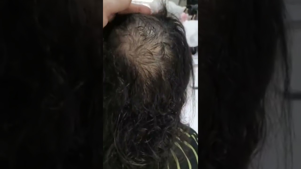 تركيب الشعر الدائم وملئ الفراغات بدون مقدمة