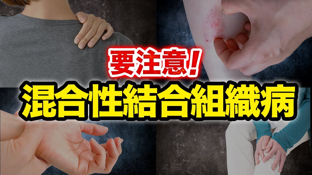 【混合性結合組織病】具体的な症状から診断方法、治療方法まで徹底解説【指定難病】【膠原病 種類】【mctd】