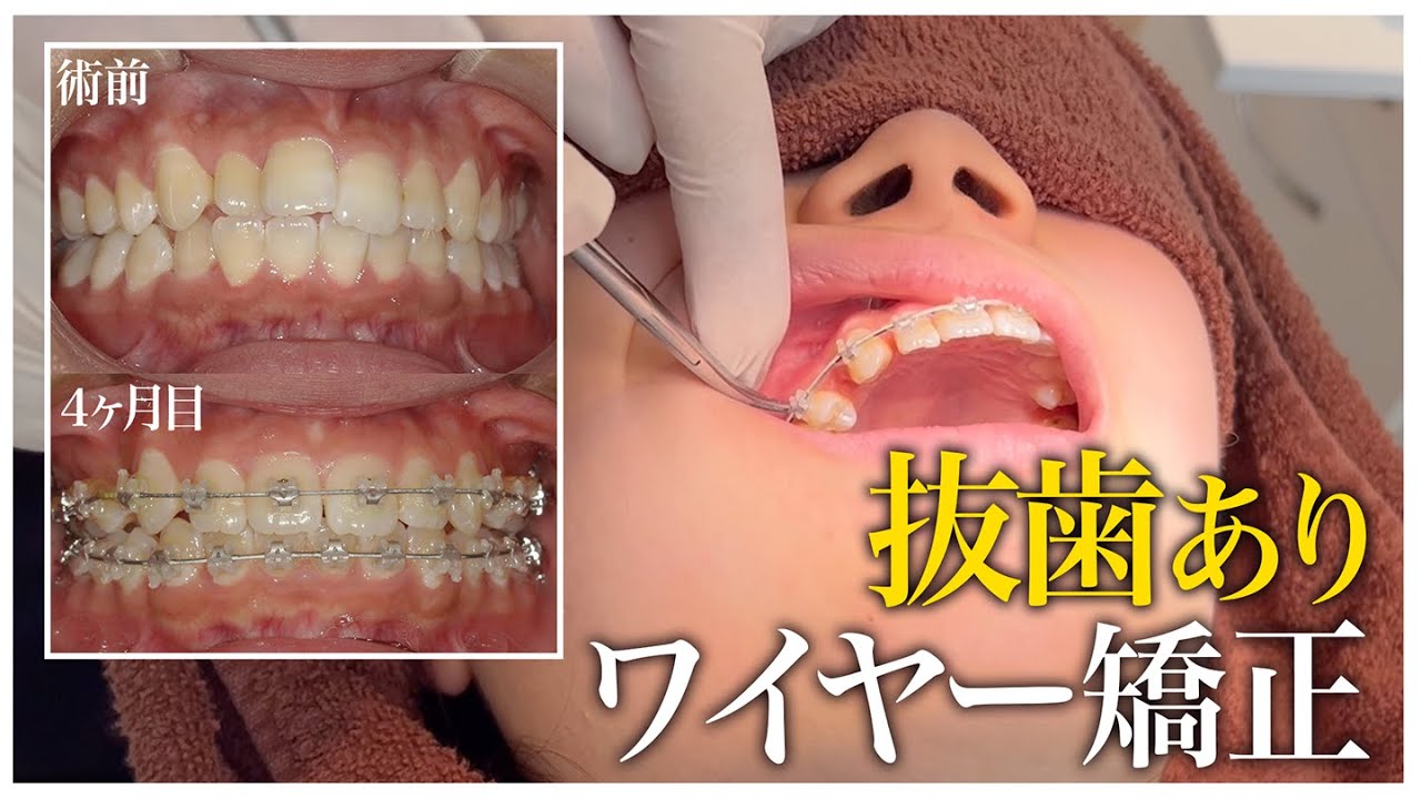 【治療4ヶ月】抜歯ありのワイヤー矯正治療の調整風景に密着【名古屋茶屋歯科・矯正歯科】