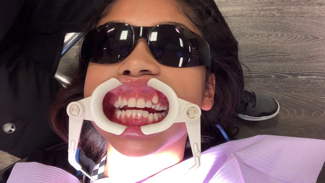 Getting my braces!
