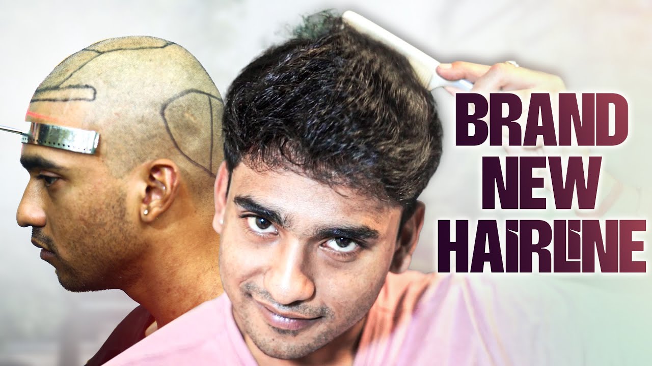 Diffuse Baldness Defeated: Watch 4500 Grafts Work Wonders 🤩 | Hair Transplant Kolkata | New Roots