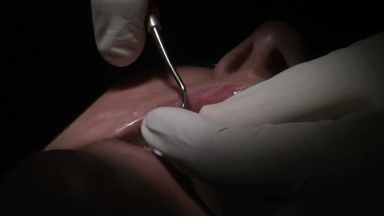 Smile make over with Dr. Parmar. Episode 13: removal of temporaries