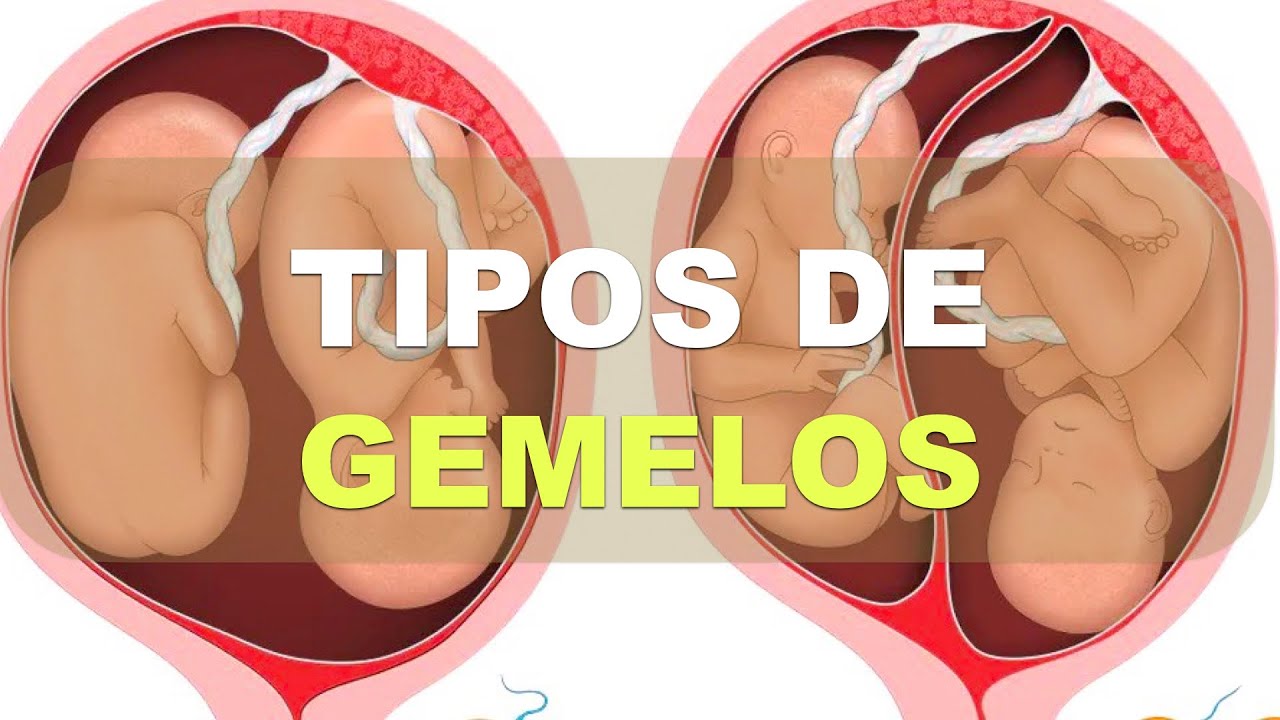 ¿Qué tipos de Gemelos hay? Explicación fisiológica