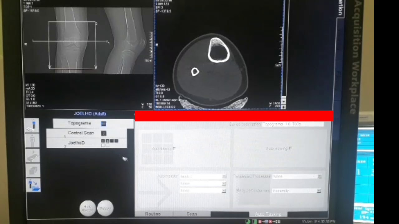 PROTOCOLO PARA JOELHO - DIEGO CESAR