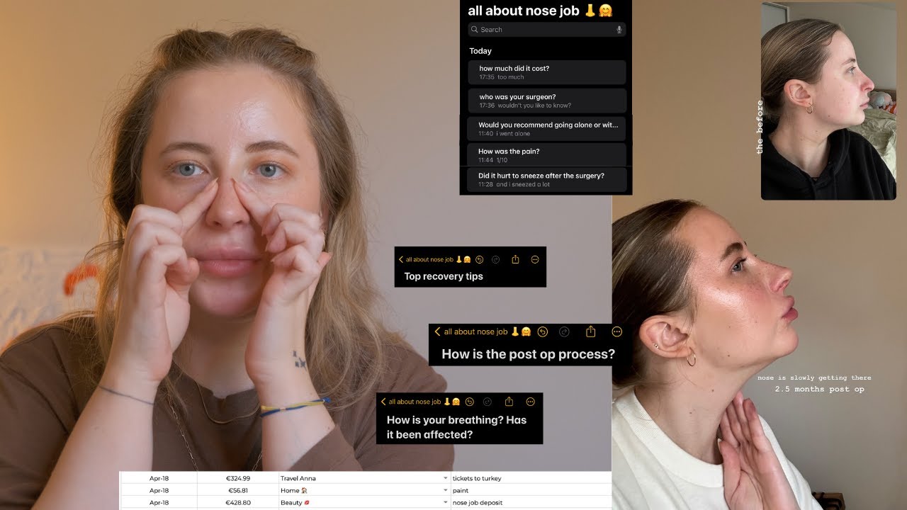my rhinoplasty experience in Istanbul, Turkey | your questions answered