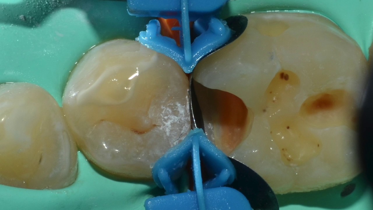 DentalПлюшки 27- матрицы Polydentia