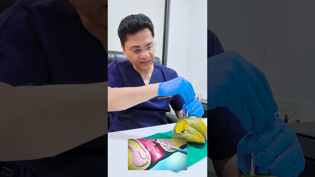 Effective Treatment for Transsphincteric Fistula: Step-by-Step Fixcision Procedure explained