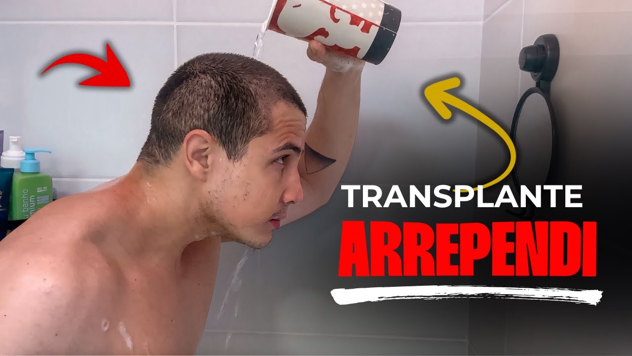 Transplante Capilar: Os Riscos Que Ningu&eacute;m te Conta | Part. 2
