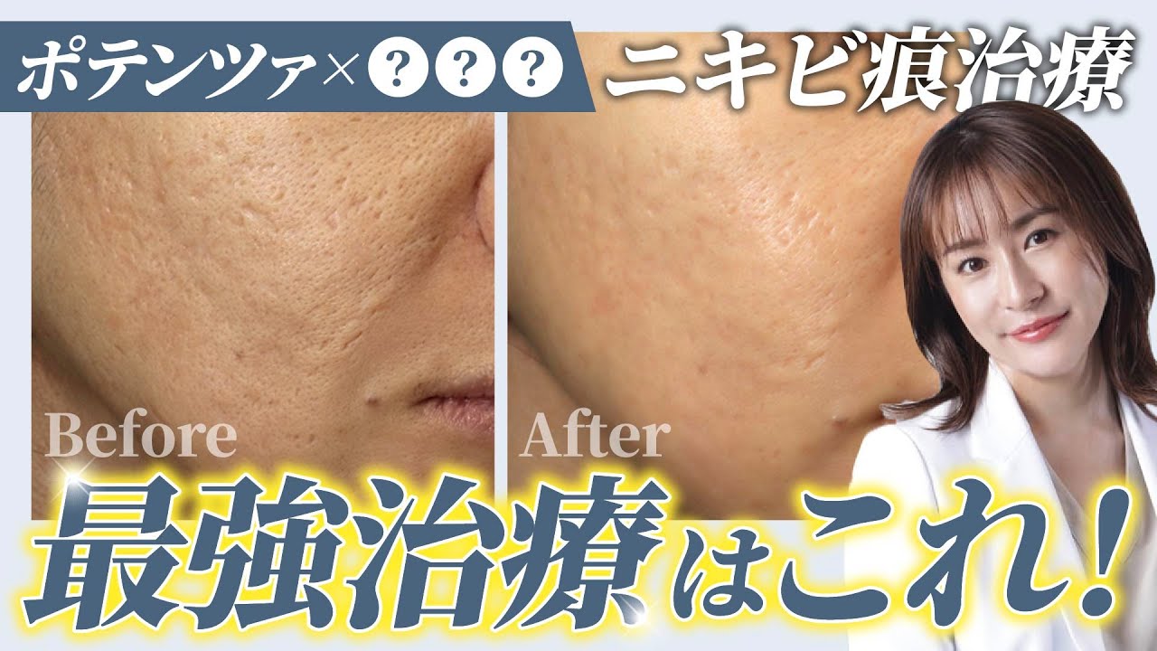 【必見】ニキビ痕が消えない人へ…ポテンツァと○○の合わせ技「ポテフィル」を徹底解説