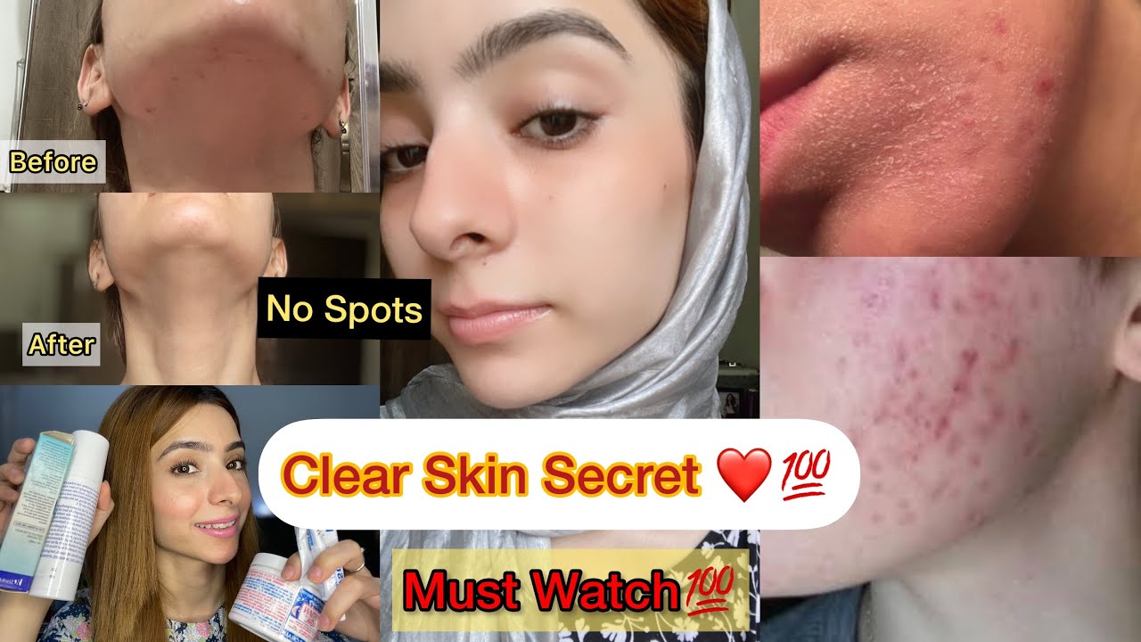 Best Treatment for Acne, Dark Spots, Pigmentation and Scars | Dermatologist Recommended Products
