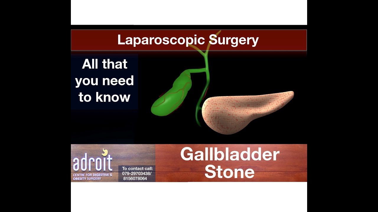 Gallbladder stone treatment/Laparoscopic surgery Patient Information, Best in Ahmedabad
