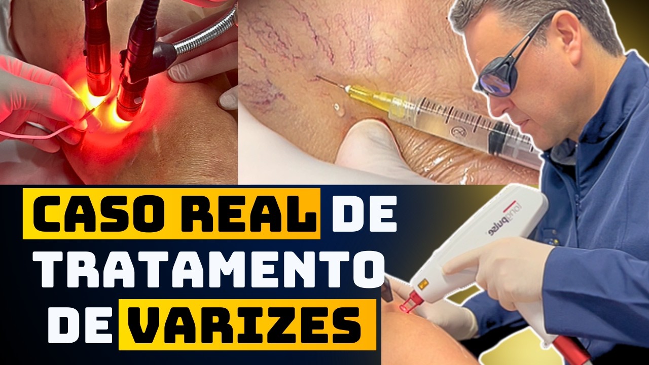 Como tratar as VARIZES nas pernas (escleroterapia espuma + laser transdérmico)