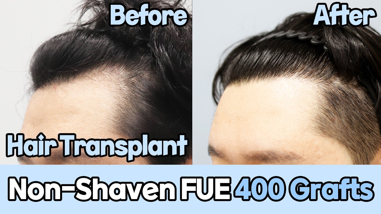 Non-Shaven FUE 400 Grafts｜Hair transplant｜Hairline correction｜SMP｜DANA