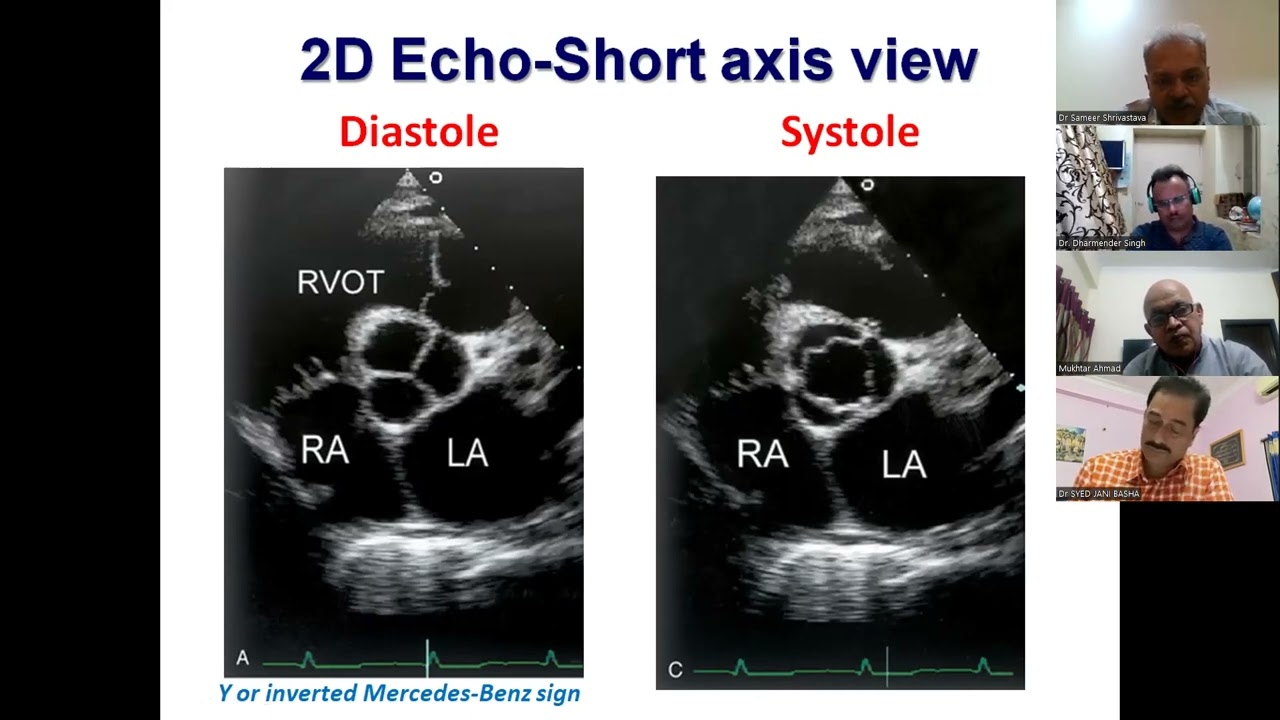 PArt 1 Aortic & Pulmonic Stenosis by Dr Sameer Shrivastava 19 May 2023