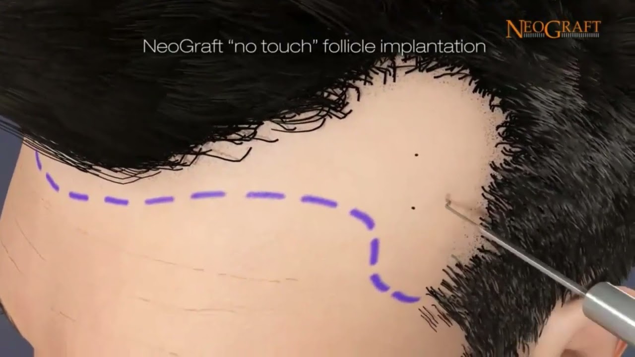 Florida NeoGraft Hair Transplant Animation at Ennis Plastic Surgery