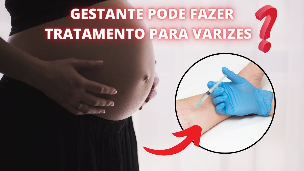 GESTANTE pode fazer tratamento para VARIZES?