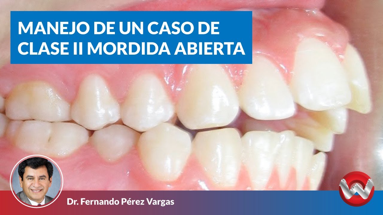 Manejo de un caso clase II mordida abierta