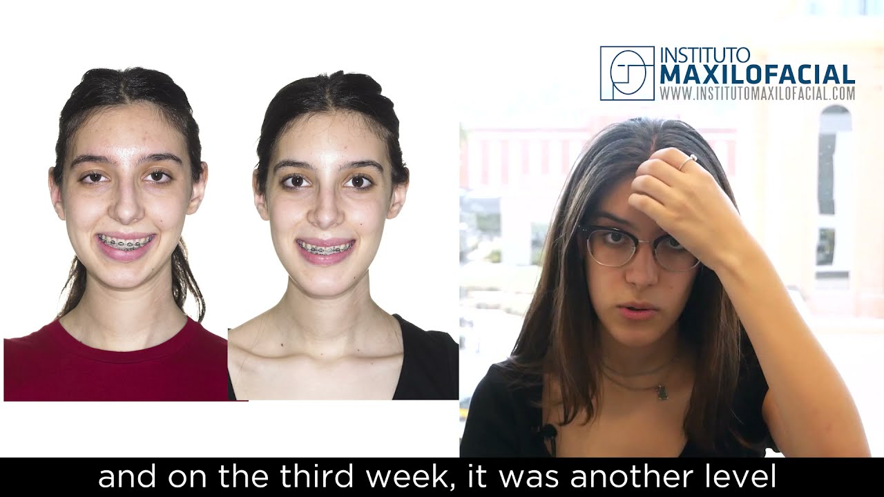 Jaw surgery Case # 87: Luna - Class II, facial asymmetry