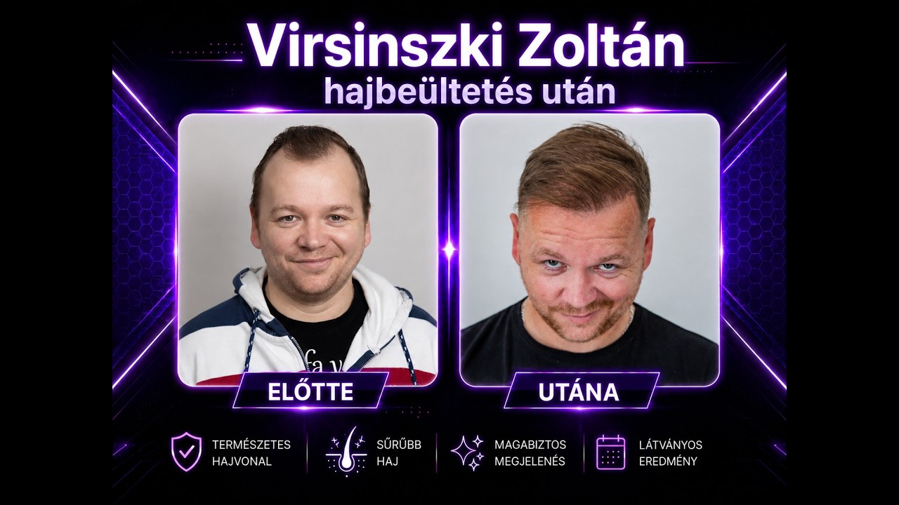 Virsinszki Zoltán hajbeültetés után - GMC Hajklinika
