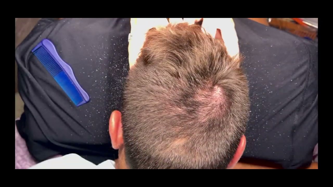 Sleeping therapy is here! #relax #sleepmusic #sleeping #relaxing #dandruff #flakes #scalpscratching