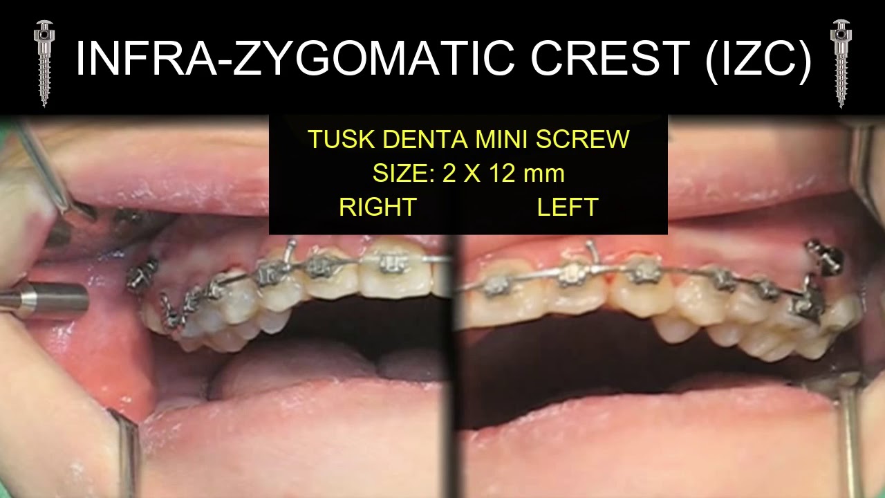 Tusk Denta Mini Screw - IZC Placement (Maxilla) Orthodontics