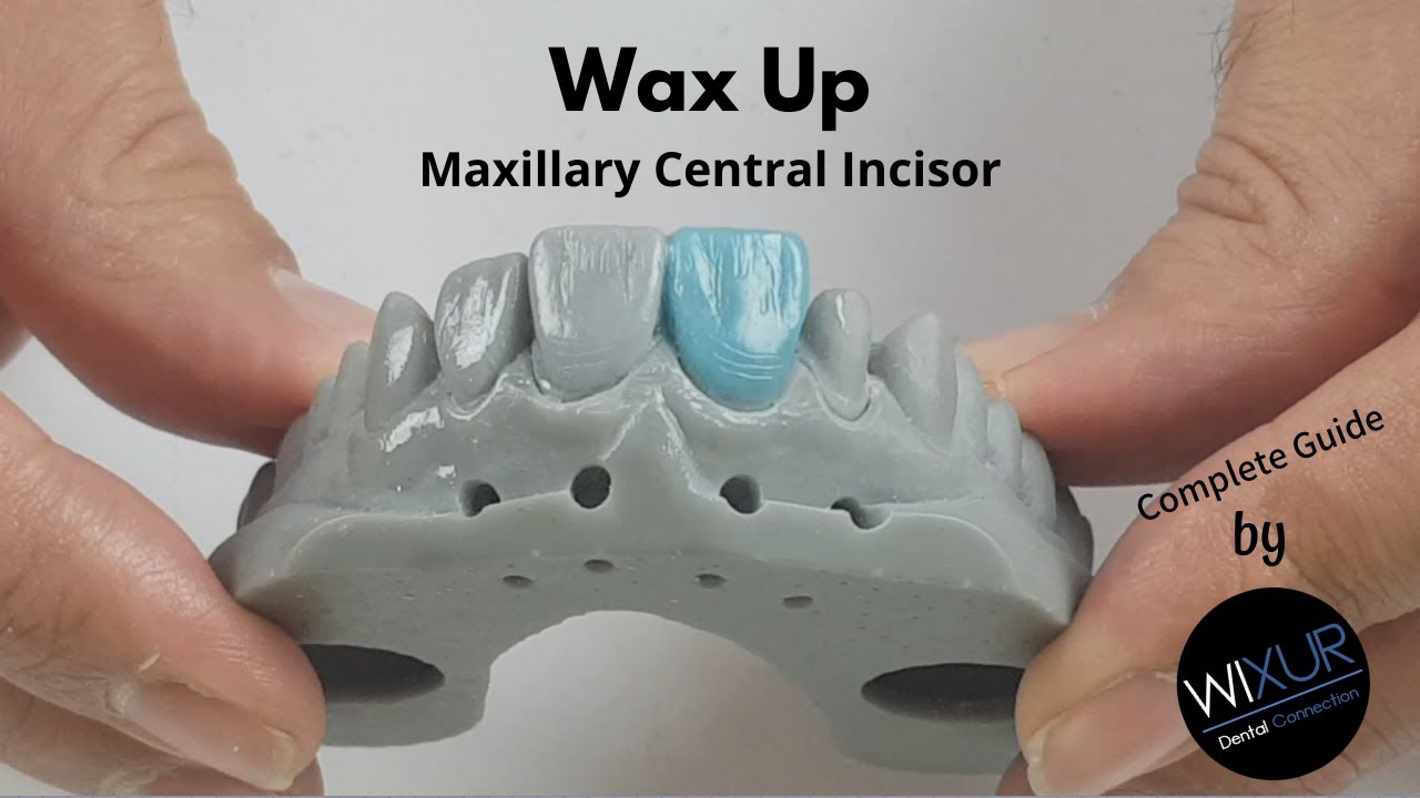 Wax Up - Maxillary Central Incisor (HD)