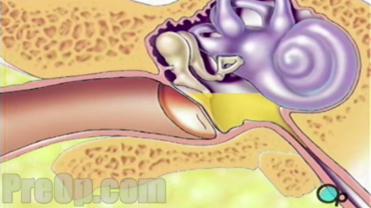 Myringotomy Insertion of Tube Surgery PreOp® Patient Education