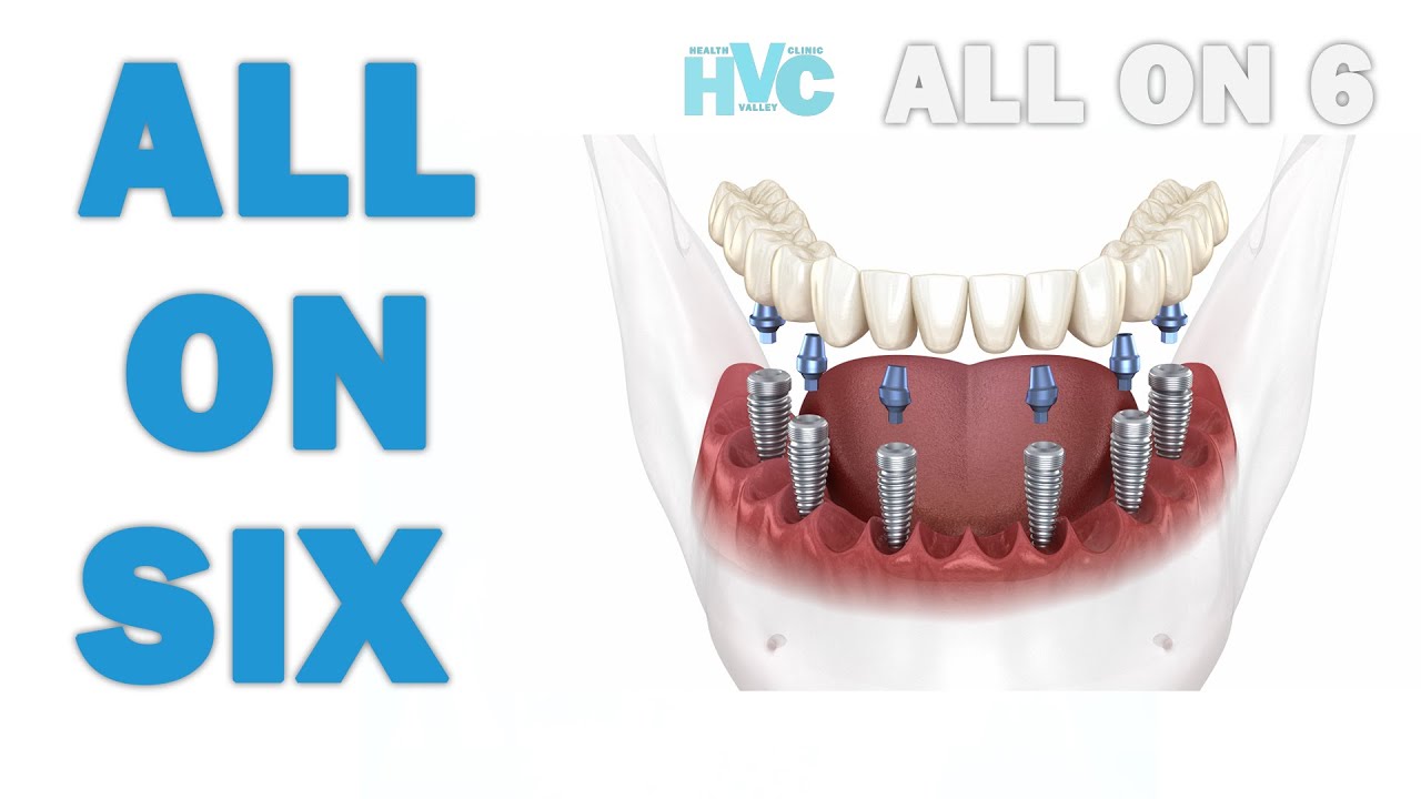 All On Six - What is all on six?