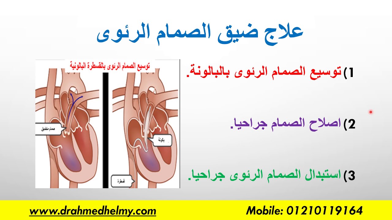 ضيق الصمام الرئوى. ماهو الصمام الرئوى وأسباب وأعراض الضيق وطرق العلاج المختلفة