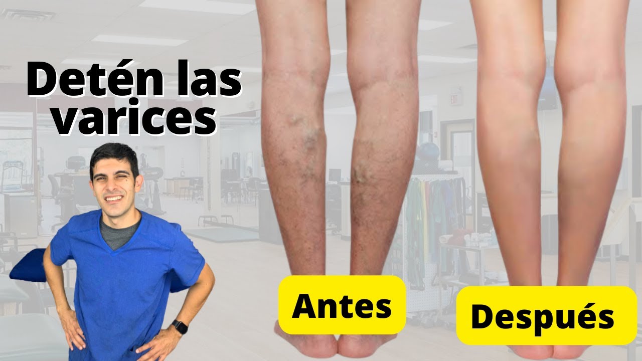 Ejercicios para ayudar a mejorar la circulación y prevenir las varices