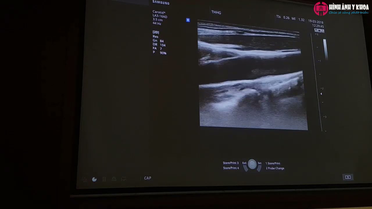 65. Hướng dẫn thực hành siêu âm Doppler động mạch cảnh – ThS.BS Nguyễn Quang Thái Dương (SATQ ĐHYD)