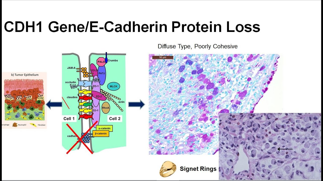 6  What is the Genetic Basis of GEC? Inherited vs Acquired CDH1 mutation/loss