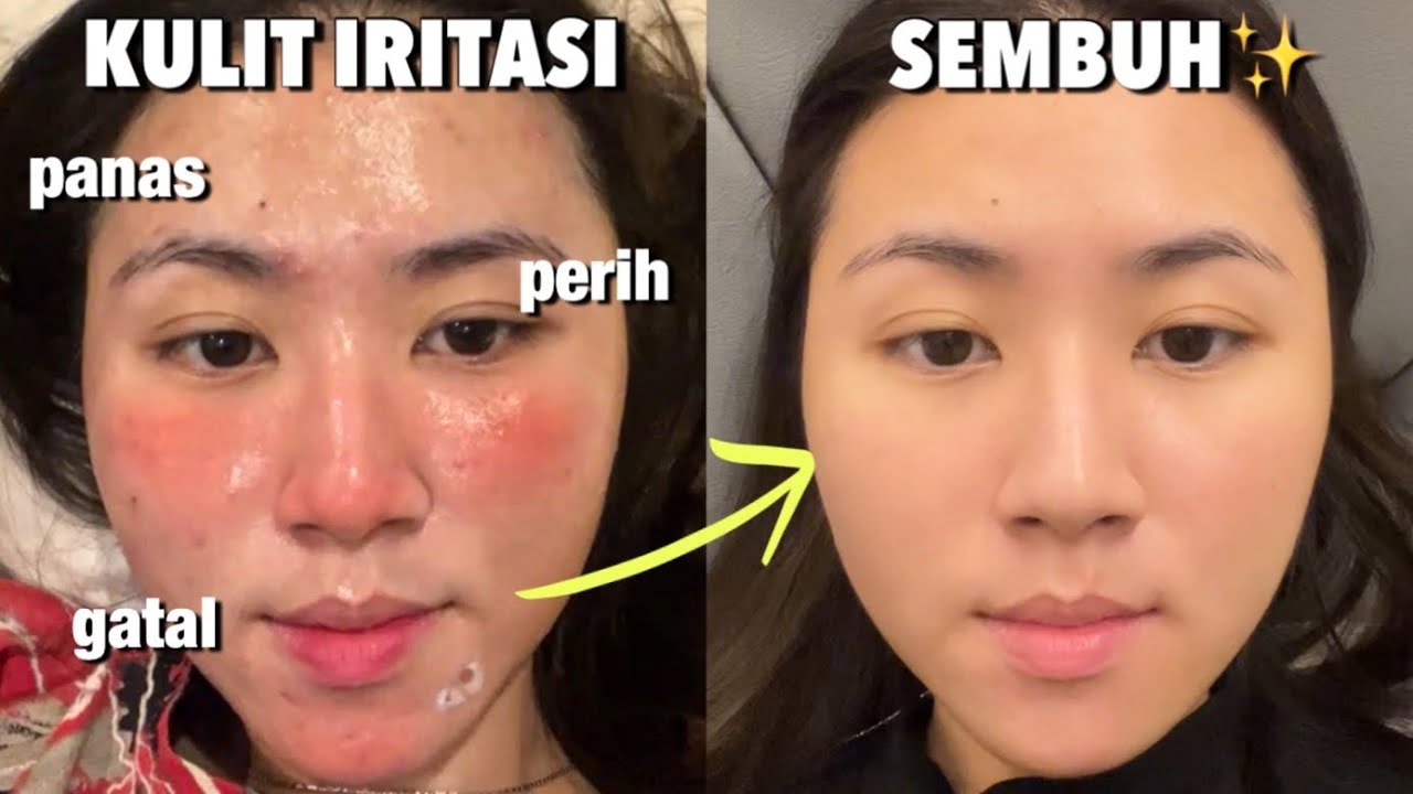 3 Tips Atasi KULIT WAJAH IRITASI dengan CEPAT! (Panas, Perih, Gatal)